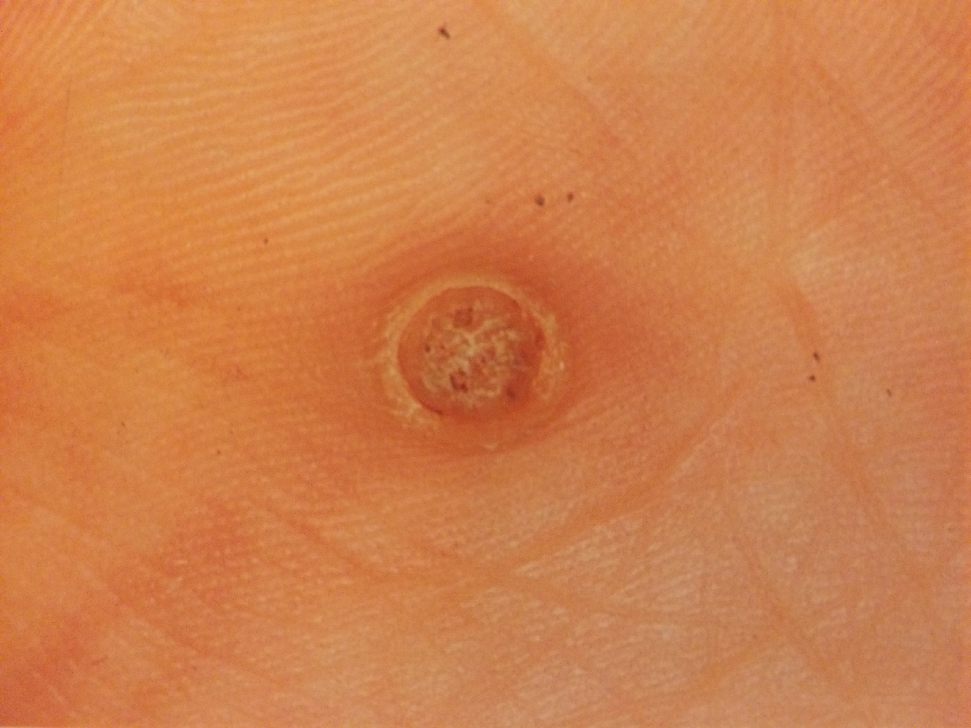 かゆみを伴うイボの原因は何ですか?