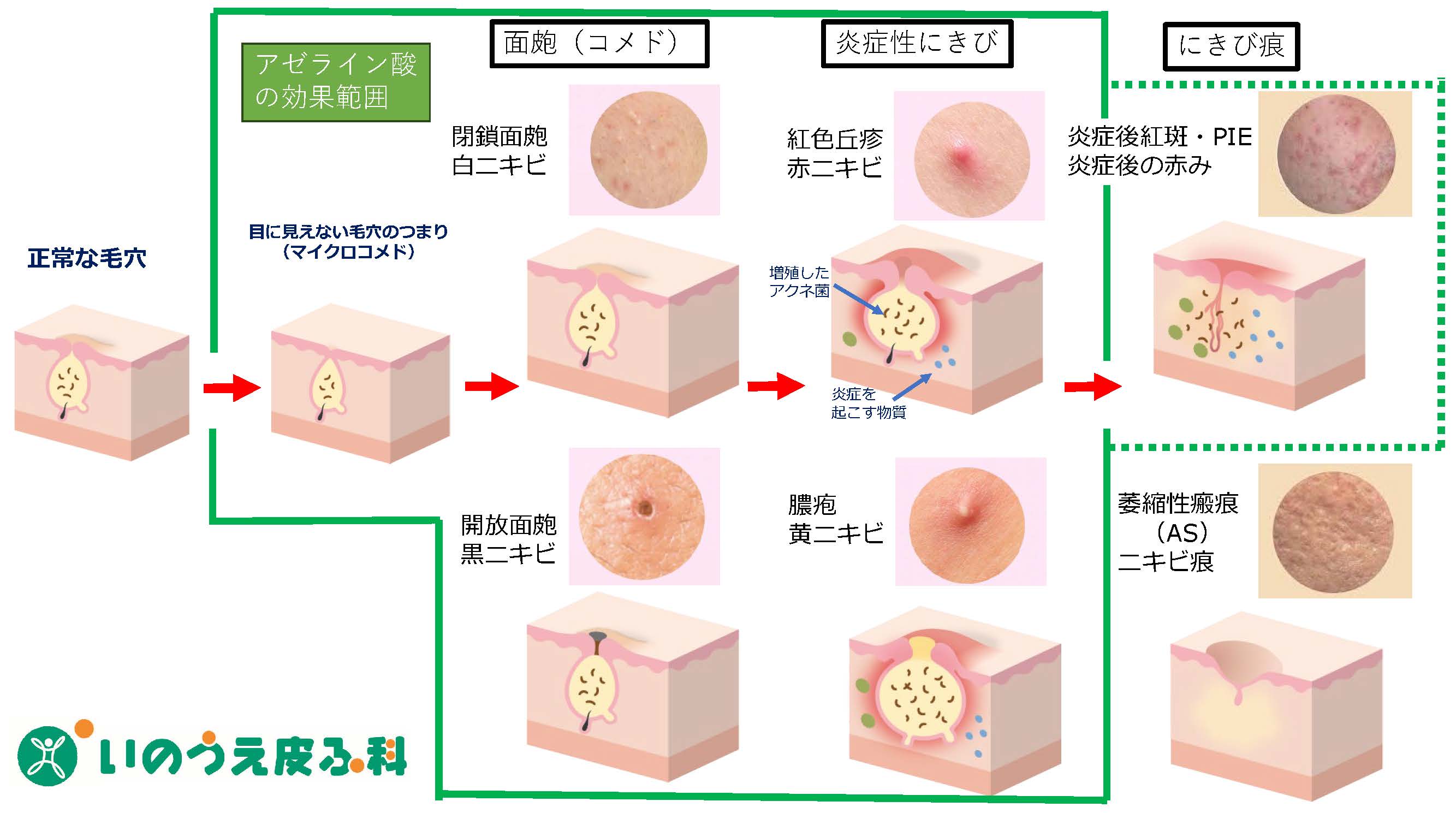 アゼライン 酸 効果