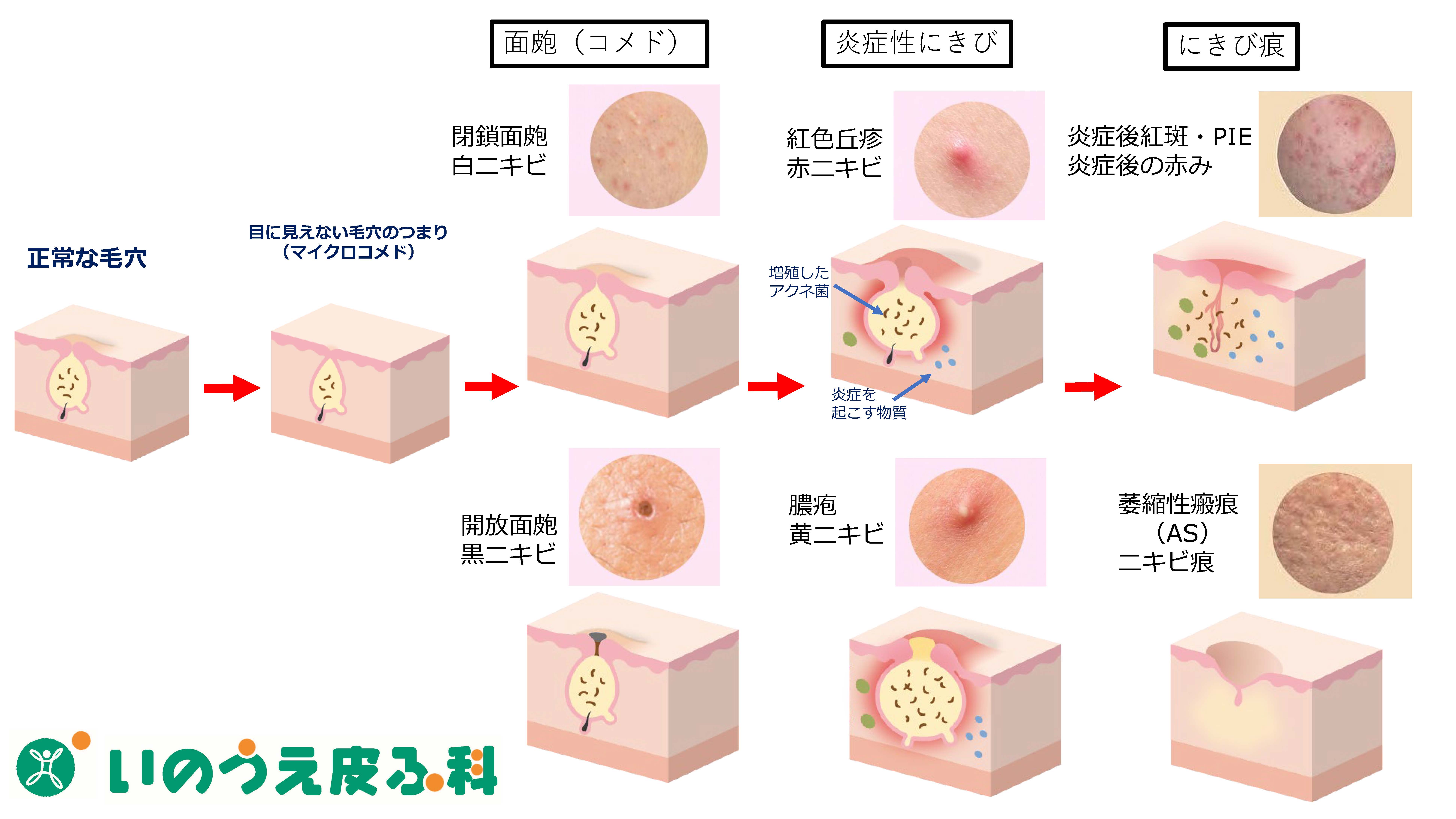 にきび 面皰_ページ_06 | 静岡市駿河区の『 いのうえ皮ふ科(井上皮膚科)』